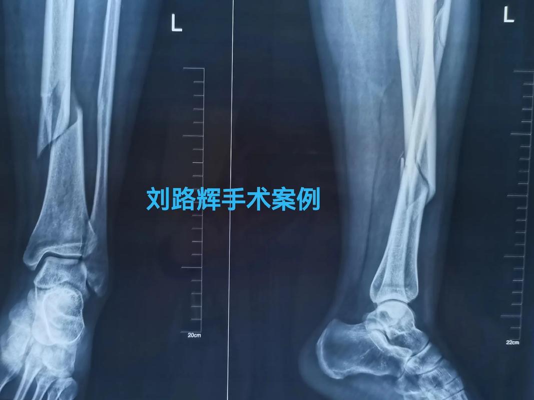 正常腿断骨成X腿;腿断骨多久才恢复